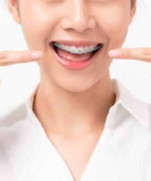 整牙＝換臉？牙齒正畸真的會(huì)改變臉型嗎？